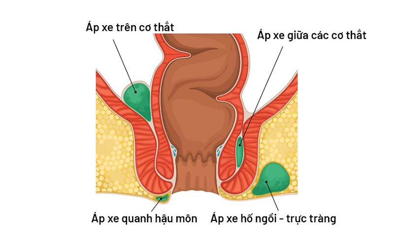 hậu môn chảy dịch vàng
