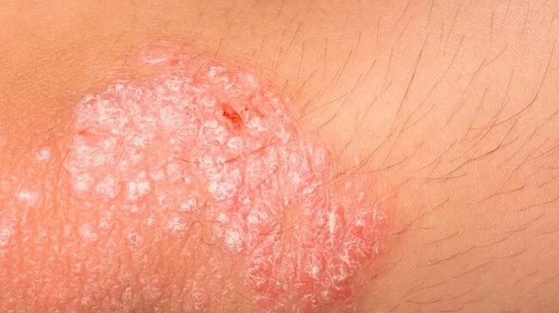 Ngứa hậu môn bị bệnh gì