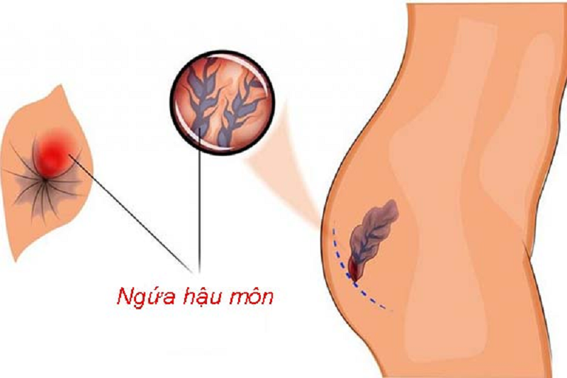 Ngứa hậu môn bị bệnh gì
