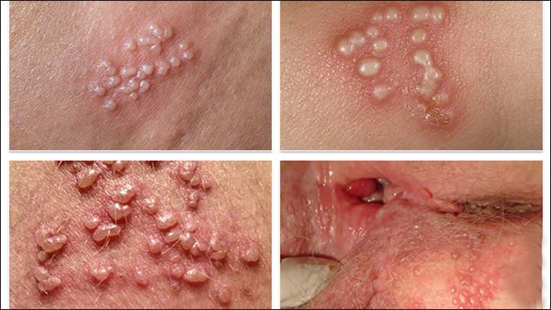 Ngứa hậu môn bị bệnh gì 