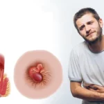 Ngứa hậu môn bị bệnh gì