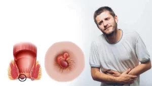 Ngứa hậu môn bị bệnh gì