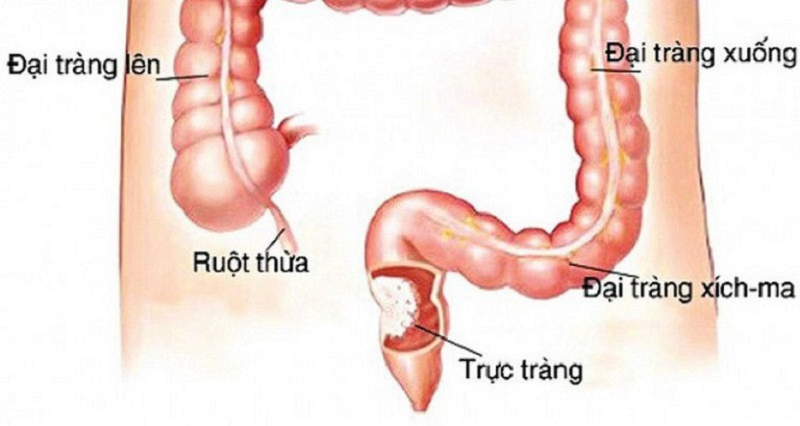 tầm soát ung thư đại tràng ở đâu
