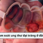 Tầm soát ung thư đại tràng ở đâu