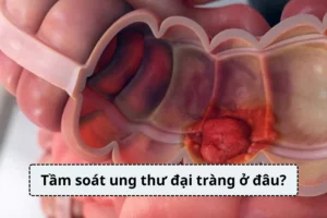 Tầm soát ung thư đại tràng ở đâu