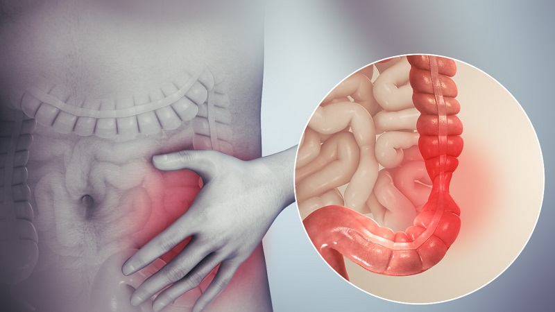 thuốc xổ nội soi đại tràng