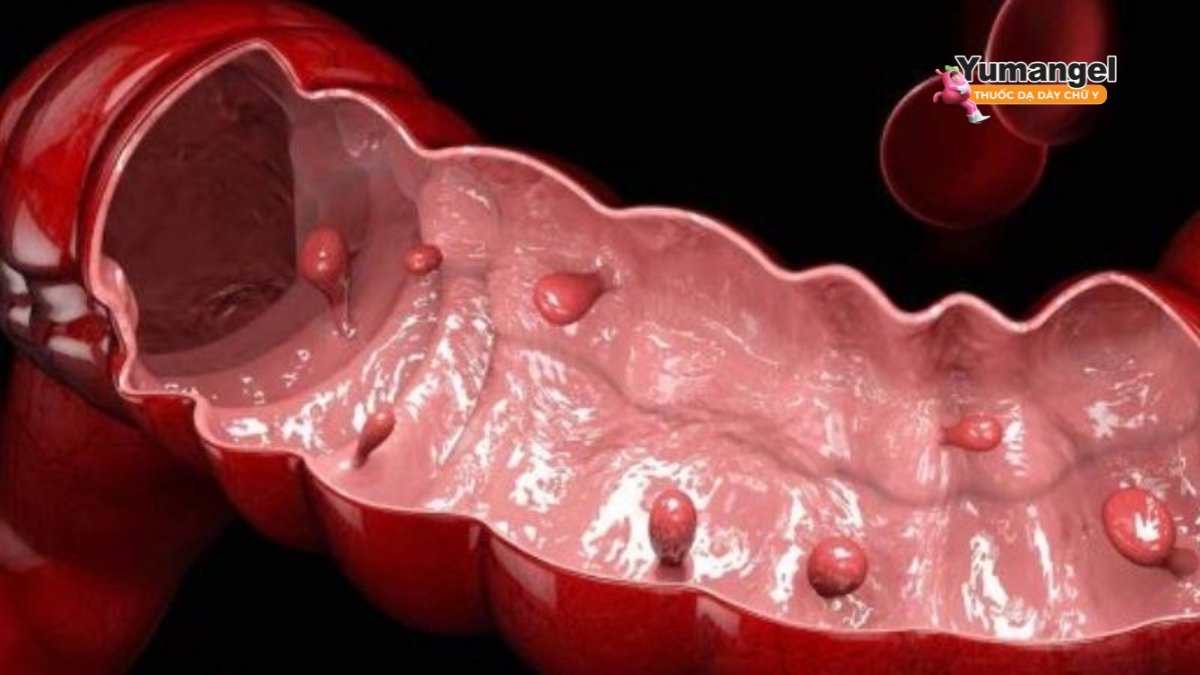 Hình ảnh minh họa polyp đại tràng