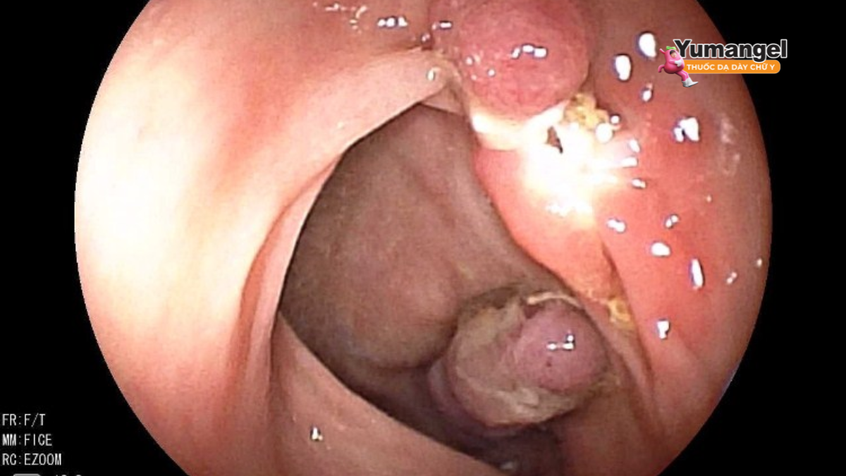 Sự xuất hiện của polyp đại tràng không được phát hiện và cắt bỏ làm tăng khả năng ung thư.