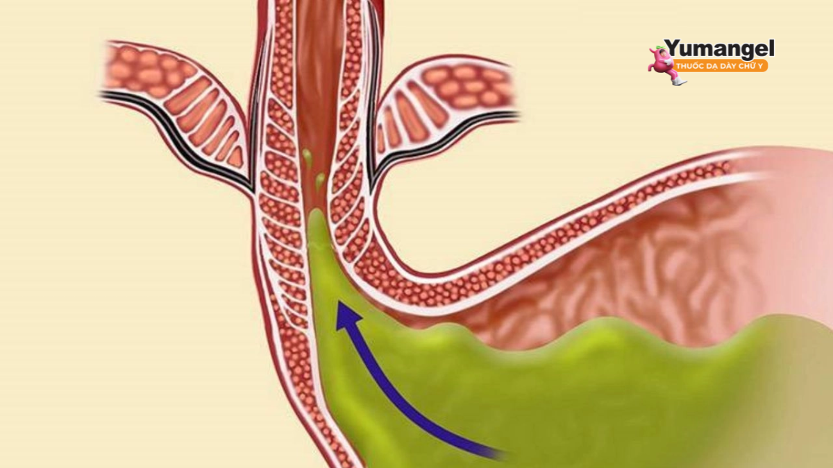 Trào ngược dạ dày gây sụt cân do kém hấp thu dinh dưỡng