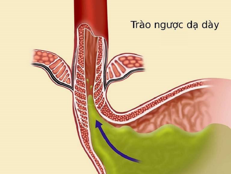 bệnh dạ dày có ảnh hưởng đến tim không