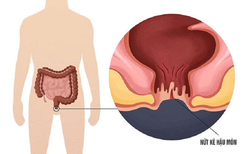cơ thắt hậu môn bị đau