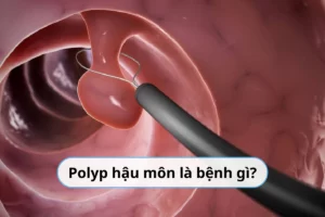 polyp hậu môn là bệnh gì