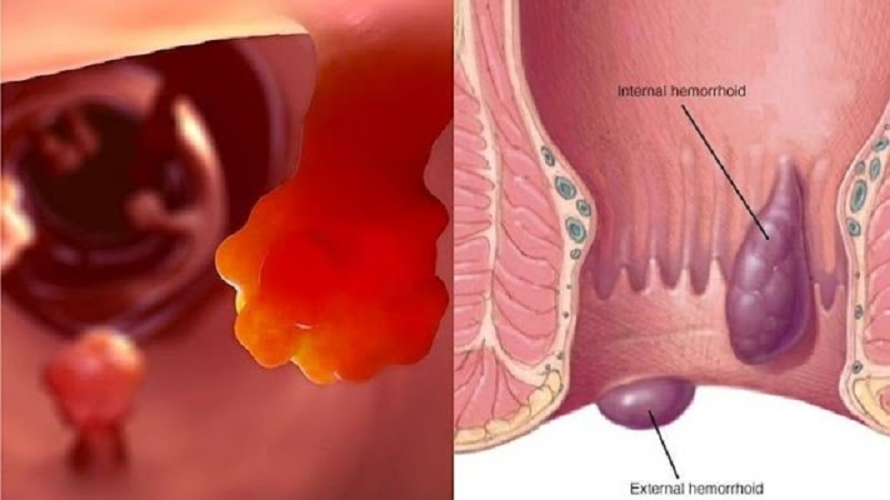 polyp hậu môn là bệnh gì