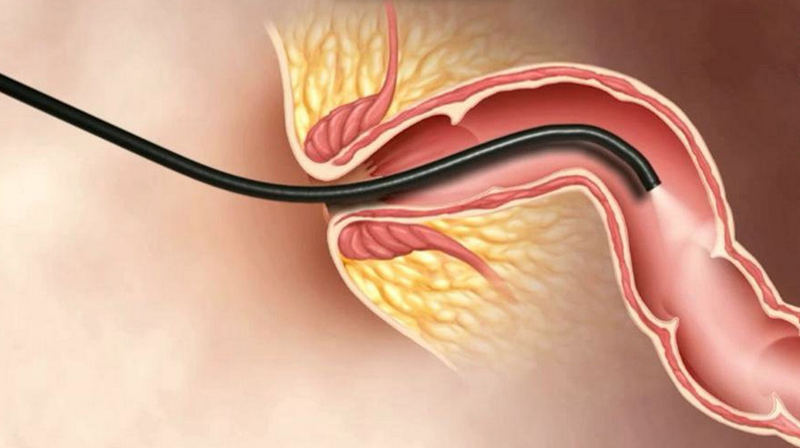 polyp hậu môn là bệnh gì