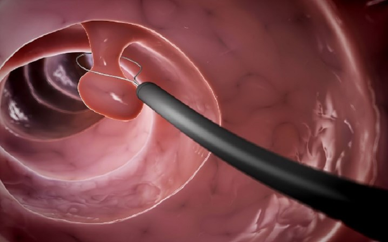 polyp hậu môn là bệnh gì