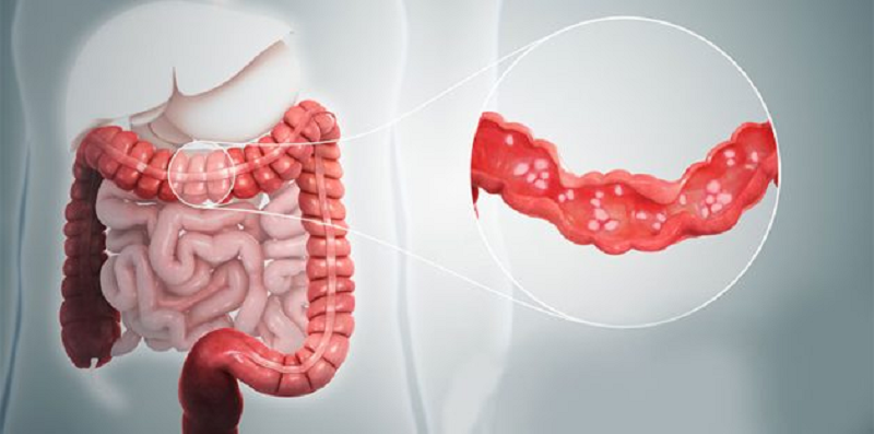 polyp hậu môn là bệnh gì