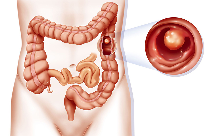 polyp hậu môn là bệnh gì