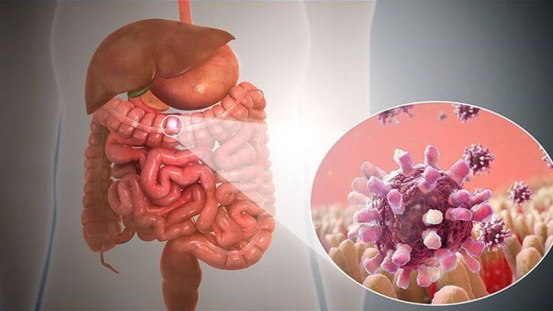 polyp hậu môn là bệnh gì