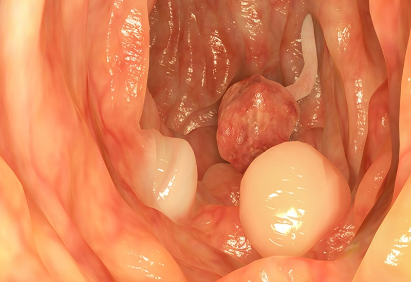 polyp hậu môn là bệnh gì