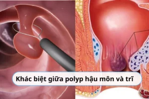 polyp hậu môn và trĩ