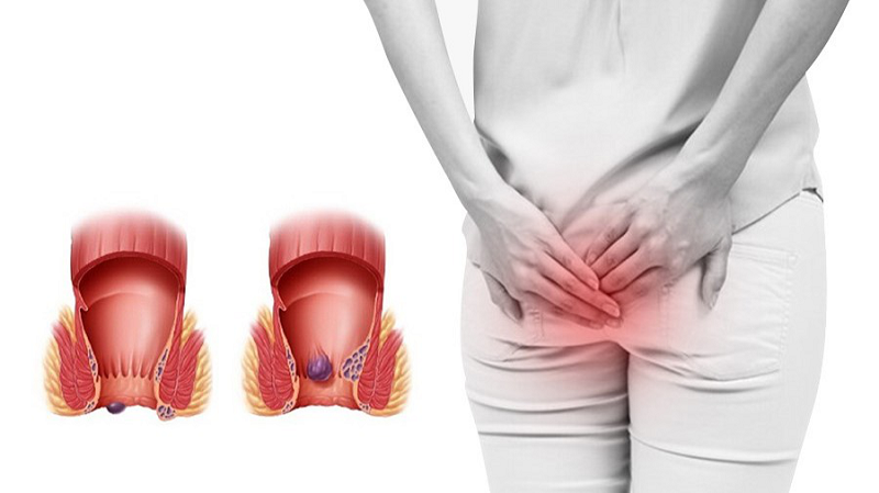 Mức độ nguy hiểm của trĩ