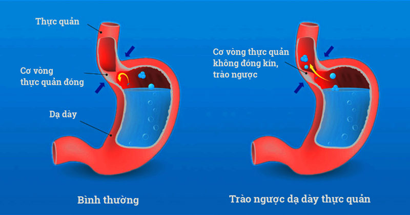 thuốc chống trào ngược dạ dày uống khi nào