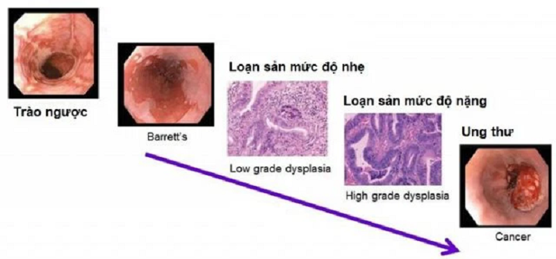 trào ngược dạ dày bao lâu thì bị ung thư
