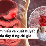 Xuất huyết dạ dày ở người già