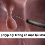 cắt polyp đại tràng có mọc lại không