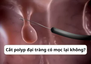 cắt polyp đại tràng có mọc lại không