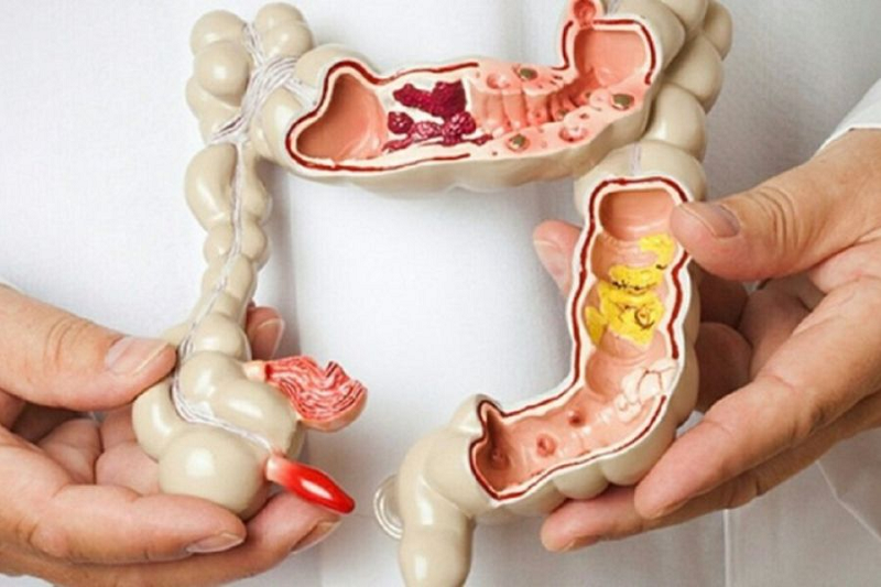 cắt polyp đại tràng có mọc lại không