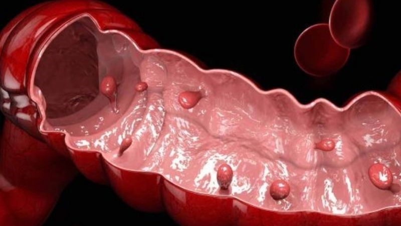 cắt polyp đại tràng có mọc lại không