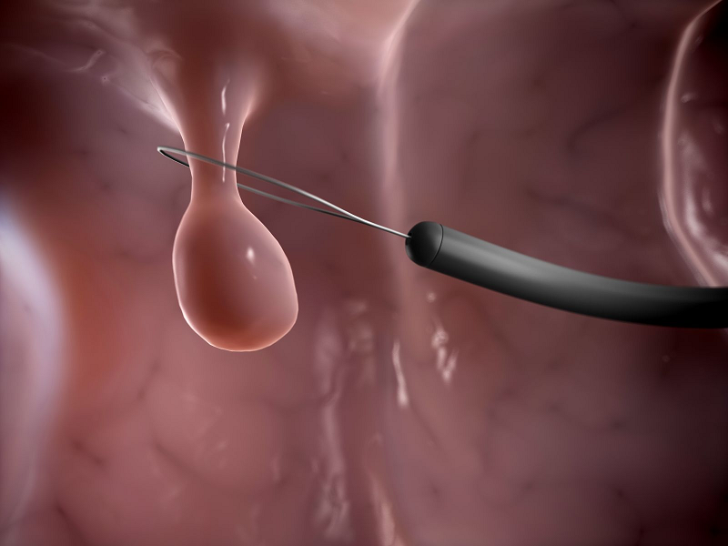 cắt polyp đại tràng có mọc lại không