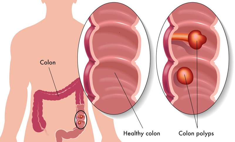 cắt polyp đại tràng có mọc lại không