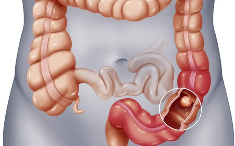 cắt polyp đại tràng có mọc lại không