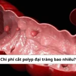 chi phí cắt polyp đại tràng