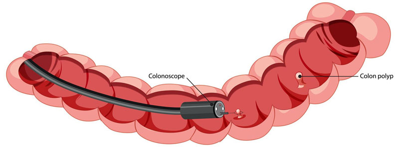 chi phí cắt polyp đại tràng