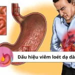 dấu hiệu viêm loét dạ dày