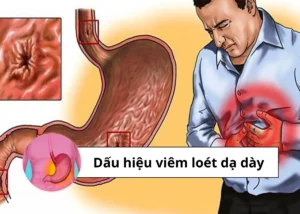 dấu hiệu viêm loét dạ dày