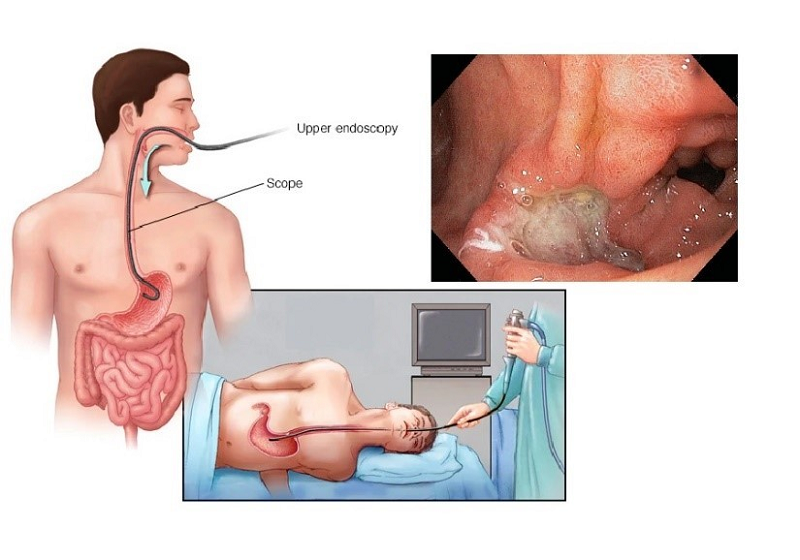 dấu hiệu viêm loét dạ dày