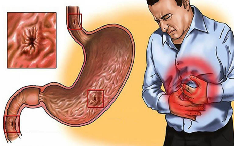 dấu hiệu viêm loét dạ dày