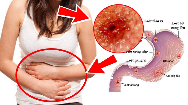 dấu hiệu viêm loét dạ dày
