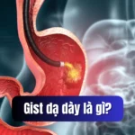 gist dạ dày là gì