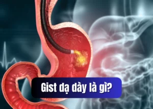gist dạ dày là gì
