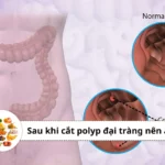 sau khi cắt polyp đại tràng nên ăn gì