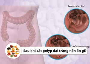 sau khi cắt polyp đại tràng nên ăn gì