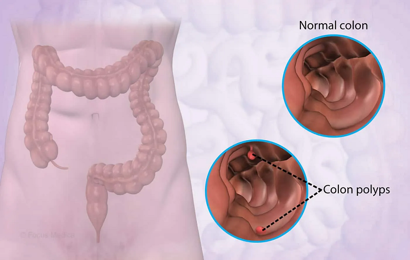 sau khi cắt polyp đại tràng nên ăn gì