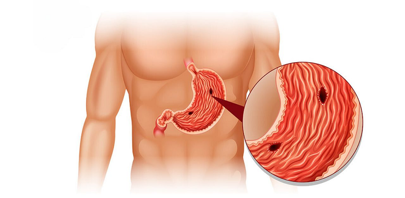 tại sao căng thẳng lại đau dạ dày