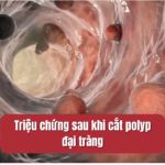 triệu chứng sau khi cắt polyp đại tràng