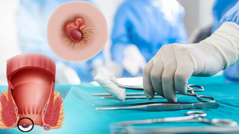 bị trĩ sau sinh có hết không